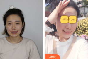 廣州穗華口腔醫(yī)院張春雷整形價(jià)格表附牙齒隱形矯正案例展示