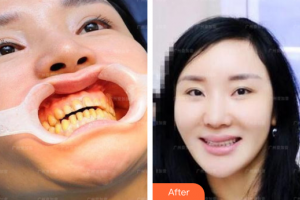 廣州穗華口腔醫(yī)院趙清桐整形價(jià)格表附瓷貼面案例展示