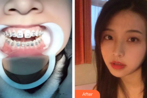 廣州穗華口腔醫(yī)院張錫金整形價(jià)格表附隱形托槽矯正案例展示