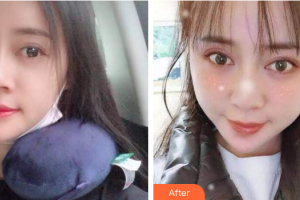 廣州穗華口腔醫(yī)院李欽濤整形價(jià)格表附自鎖托槽矯正案例展示