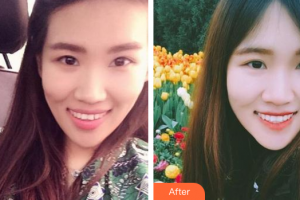 廣州穗華口腔醫(yī)院李澤鍵整形價(jià)格表附牙齒隱形矯正案例展示