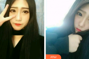 廣州穗華口腔醫(yī)院張修學(xué)整形價(jià)格表附時(shí)代天使矯正案例展示