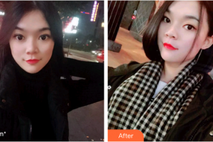 廣州穗華口腔醫(yī)院劉敏義整形價(jià)格表附時(shí)代天使矯正案例展示