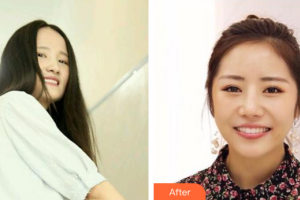 廣州穗華口腔醫(yī)院張濤整形價(jià)格表附隱形牙套矯正案例展示