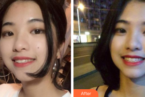 廣州穗華口腔醫(yī)院聶謝超整形價(jià)格表附隱形牙齒矯正案例展示