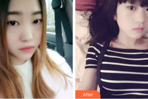 廣州穗華口腔醫(yī)院姜力整形價(jià)格表附牙齒金屬矯正案例展示