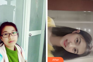 廣州穗華口腔醫(yī)院陳凌鋒整形價(jià)格表附牙齒矯正案例展示