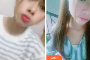 廣州穗華口腔醫(yī)院夏麗梅整形價(jià)格表附牙齒根管調(diào)節(jié)案例展示