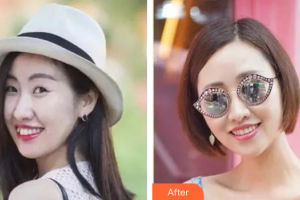 廣州穗華口腔醫(yī)院梁倩整形價(jià)格表附隱形托槽矯正案例展示