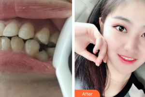 廣州穗華口腔醫(yī)院張建整形價(jià)格表附金屬托槽矯正案例展示