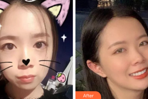 廣州穗華口腔醫(yī)院華志熙整形價(jià)格表附牙齒矯正案例展示