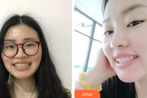 廣州穗華口腔醫(yī)院李奇?zhèn)フ蝺r格表附牙齒金屬矯正案例展示