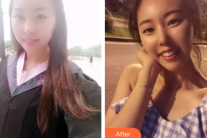 廣州暨博口腔醫(yī)院王琦整形價格表附陶瓷矯正牙齒案例展示