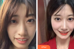 廣州瑞德口腔醫(yī)院汪贏整形價格表附牙齒矯正案例展示