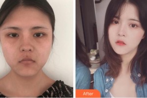杭州整形醫(yī)院何葆華整形價(jià)格表附埋線提升案例展示