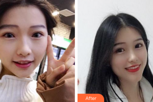 廣州愛康健口腔門診部盧勇輝整形價(jià)格表附隱形矯正案例展示