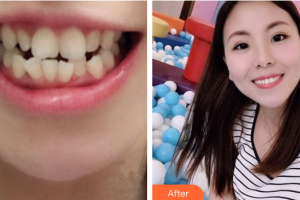 廣州健業(yè)口腔醫(yī)院安斯耀整形價格表附金屬托槽矯正案例展示