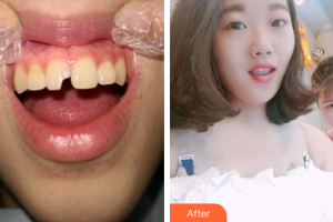 廣州愛康健口腔門診部田振揚整形價格表附瓷貼面案例展示