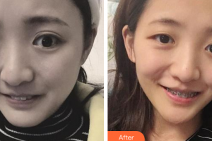 廣州愛康健口腔門診部黃建榮整形價格表附牙齒金屬矯正案例展示