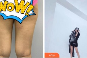 杭州新友好整形醫(yī)院韓美貞整形價(jià)格表附大腿吸脂案例展示