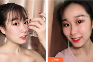 廣州愛康健口腔門診部馮曉瑛整形價格表附牙齒隱形矯正案例展示