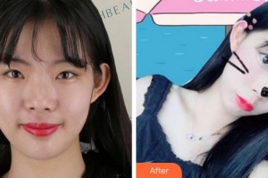 杭州格萊美整形美容醫(yī)院姚建民整形價格表附熱瑪吉案例展示