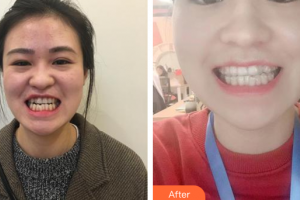 廣州市荔灣區(qū)口腔醫(yī)院任柏林整形價(jià)格表附隱形牙齒矯正案例展示