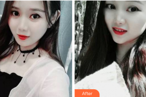 廣州愛康健口腔門診部黃茲谷整形價(jià)格表附牙齒隱形矯正案例展示