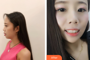 廣州市荔灣區(qū)口腔醫(yī)院崔亞琪整形價(jià)格表附牙齒矯正案例展示