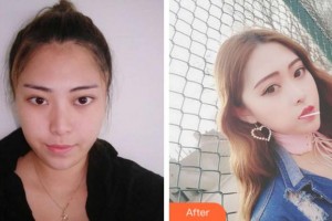 杭州珍美顏醫(yī)療美容診所陳永整形價格表附鼻部綜合案例展示