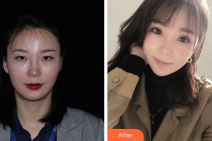 杭州麗欣醫(yī)療美醫(yī)院顧飚整形價格表附眼部綜合案例展示