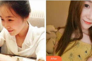 杭州珈禾整形美容醫(yī)院管嵐整形價格表附熱瑪吉案例展示