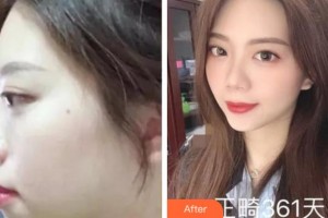 杭州珈禾整形美容醫(yī)院馮應宏整形價格表附金屬托槽矯正案例展示