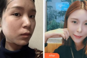 杭州新生毛發(fā)種植研究院姜蘇整形價格表附種植發(fā)際線案例展示