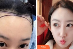 杭州新生毛發(fā)種植研究院甘柳明整形價格表附種植發(fā)際線案例展示