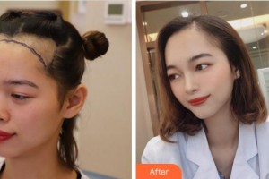 杭州新生毛發(fā)種植研究院段天文整形價格表附種植發(fā)際線案例展示