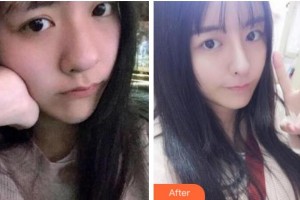 杭州君曼醫(yī)療美容會所黃君曼整形價格表附熱瑪吉案例展示