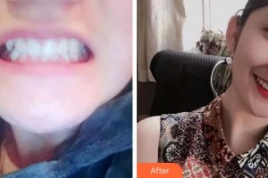 杭州時光醫(yī)療美容醫(yī)院葉學功整形價格表附牙齒陶瓷矯正案例展示