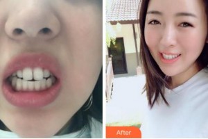 杭州時光醫(yī)療美容醫(yī)院陳義忠整形價格表附金屬托槽矯正案例展示