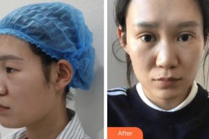 杭州麗欣醫(yī)療美醫(yī)院徐丹整形價格表附眼部綜合案例展示