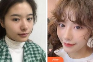 杭州維多利亞醫(yī)療美容醫(yī)院胡珊鶯整形價(jià)格表附熱瑪吉案例展示