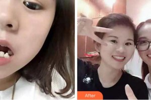 杭州維多利亞醫(yī)療美容醫(yī)院劉吉利整形價(jià)格表附牙齒陶瓷矯正案例展示