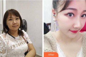 杭州格萊美整形美容醫(yī)院李穎整形價(jià)格表附鼻中隔軟骨隆鼻案例展示