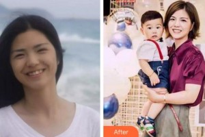 杭州格萊美整形美容醫(yī)院許水華住院醫(yī)師整形價(jià)格表附牙齒隱形矯正案例展示