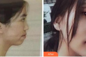 杭州愛琴海醫(yī)療美容醫(yī)院馬奇整形價(jià)格表附金屬托槽矯正案例展示