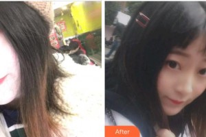 杭州時(shí)光醫(yī)療美容醫(yī)院金楨粲整形價(jià)格表附金屬托槽矯正案例展示