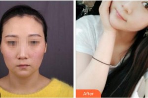 杭州華山連天美醫(yī)療美容整形醫(yī)院金圣浩整形價格表附埋線提升案例展示