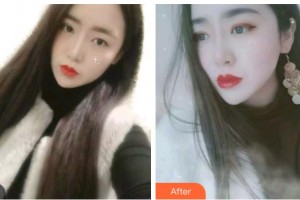 杭州整形醫(yī)院張振亮整形價格表附金屬托槽矯正案例展示