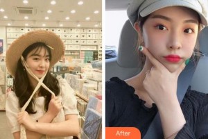 杭州整形醫(yī)院楊甄宇整形價格表附熱拉提案例展示