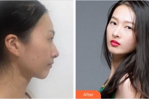 杭州靜港醫(yī)療美容診所林忠泵整形價格表附鼻部綜合案例展示